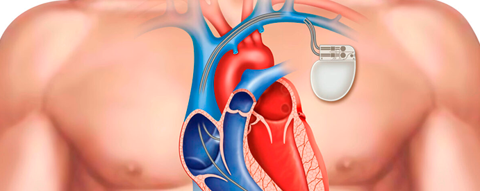 O que devemos saber a respeito do período imediatamente após o implante de marcapasso cardíaco?